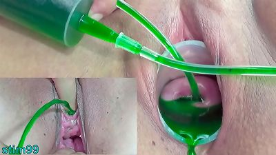 Cervix and pee hole Inflation with insertions for asian lesbians